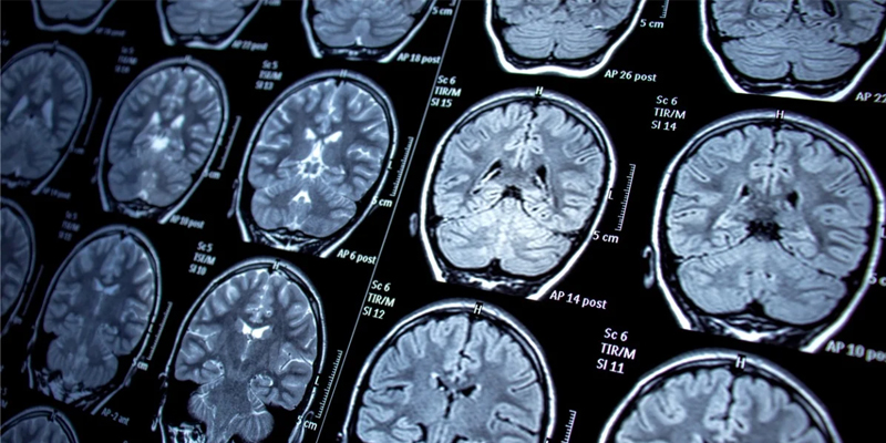 Brain Tumour Scans