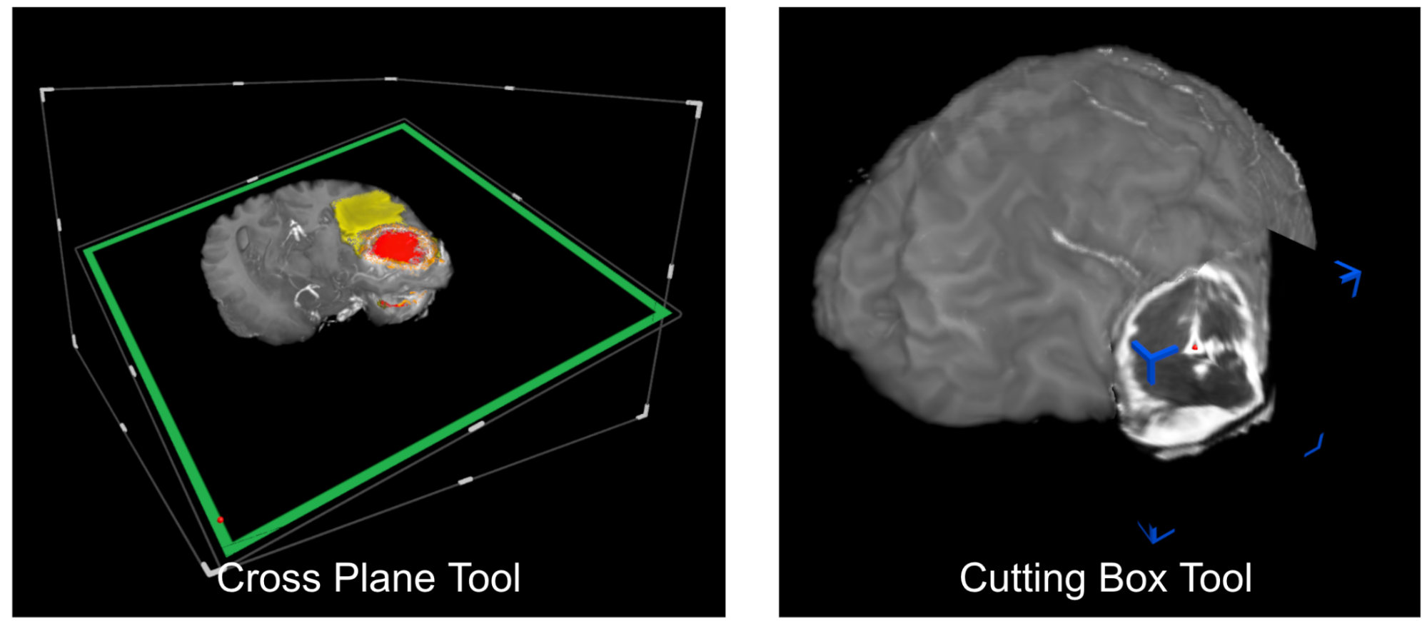  Brain Tumour Segmentation