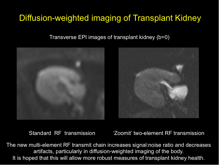 Imaging of Transplant Kidney