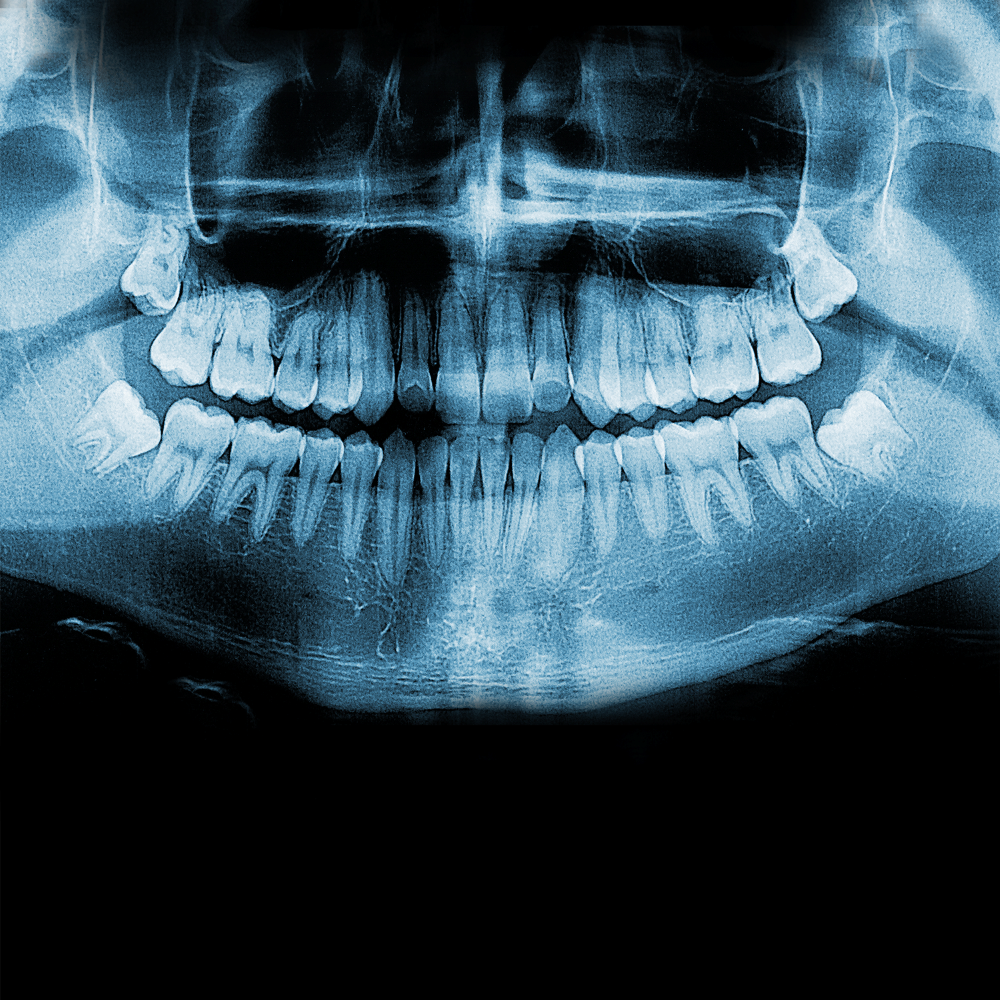 Dental x-ray of a jaw and teeth showing the wisdom teeth, which are set up and away from the other teeth.