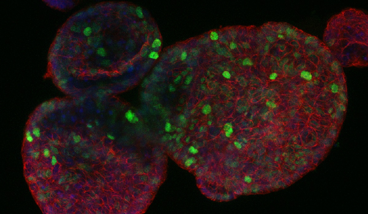 Image of an intestinal tumour organoid, which has the same molecular features as the 'born to be bad' patient CRC tumours.