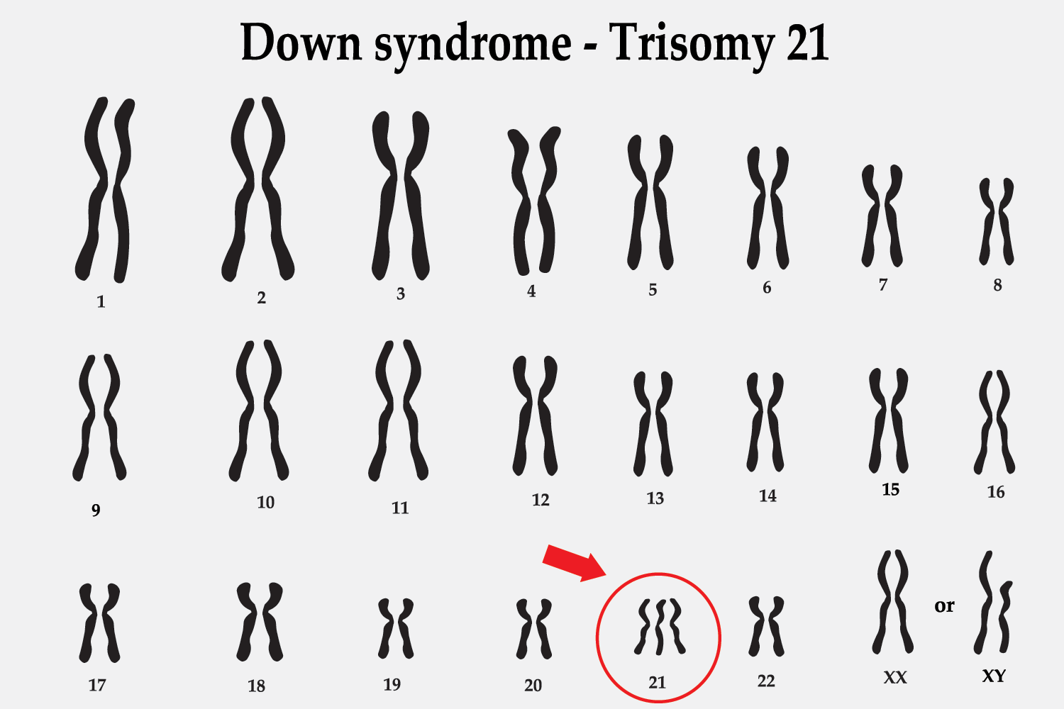 An image of the chromosomes and the extra copy chromosome 21 (trisomy 21), resulting in the genetic condition known as Down Syndrome.