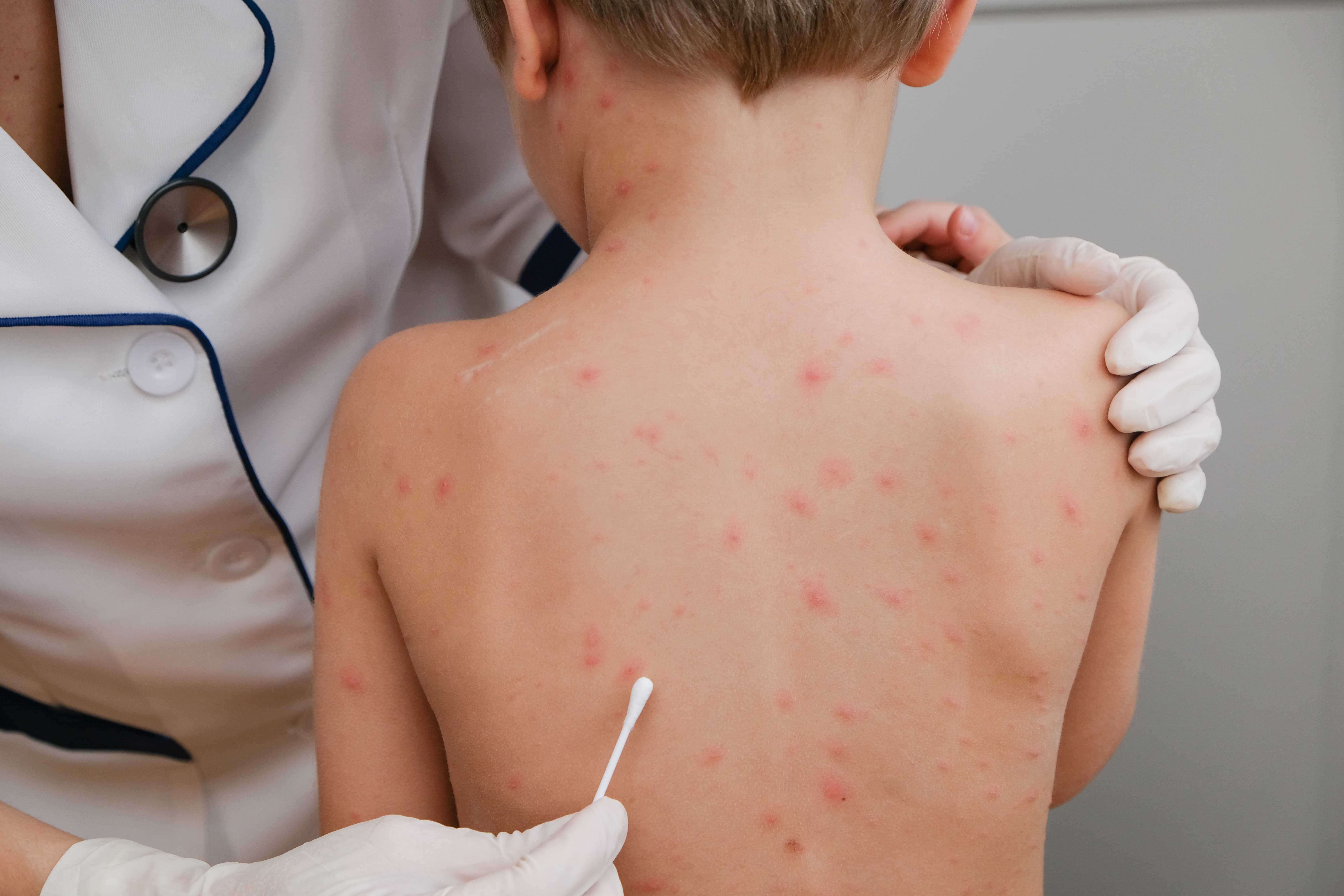 Baby skin with blisters and rash caused by chickenpox.