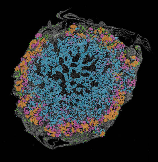 Spatial transcriptomic map of a day 20 human kidney organoid, showing podocytes (pink), proximal tubules (orange), distal and medial nephron cells (blue), endothelial cells (green), and stromal cells (grey). The image was generated using the 10x