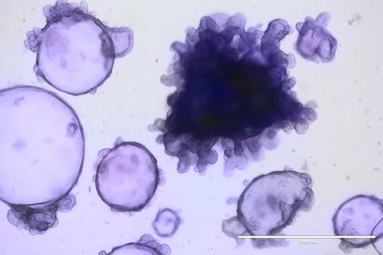 3D models help researchers study the disease in living tissue in the lab, allowing them to develop and test new therapies. 