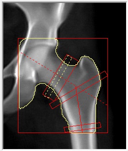Hip analysis