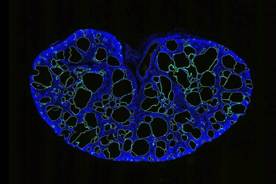 Image of a murine kidney with autosomal dominant polycystic kidney disease. Green represents collecting duct epithelia and their derived cysts. Blue represents DAPI staining of nuclei. Tissue preparation, sectioning and staining were performed by Dr