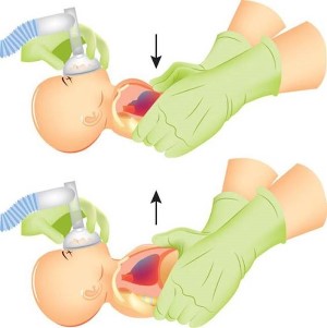 High risk newborn