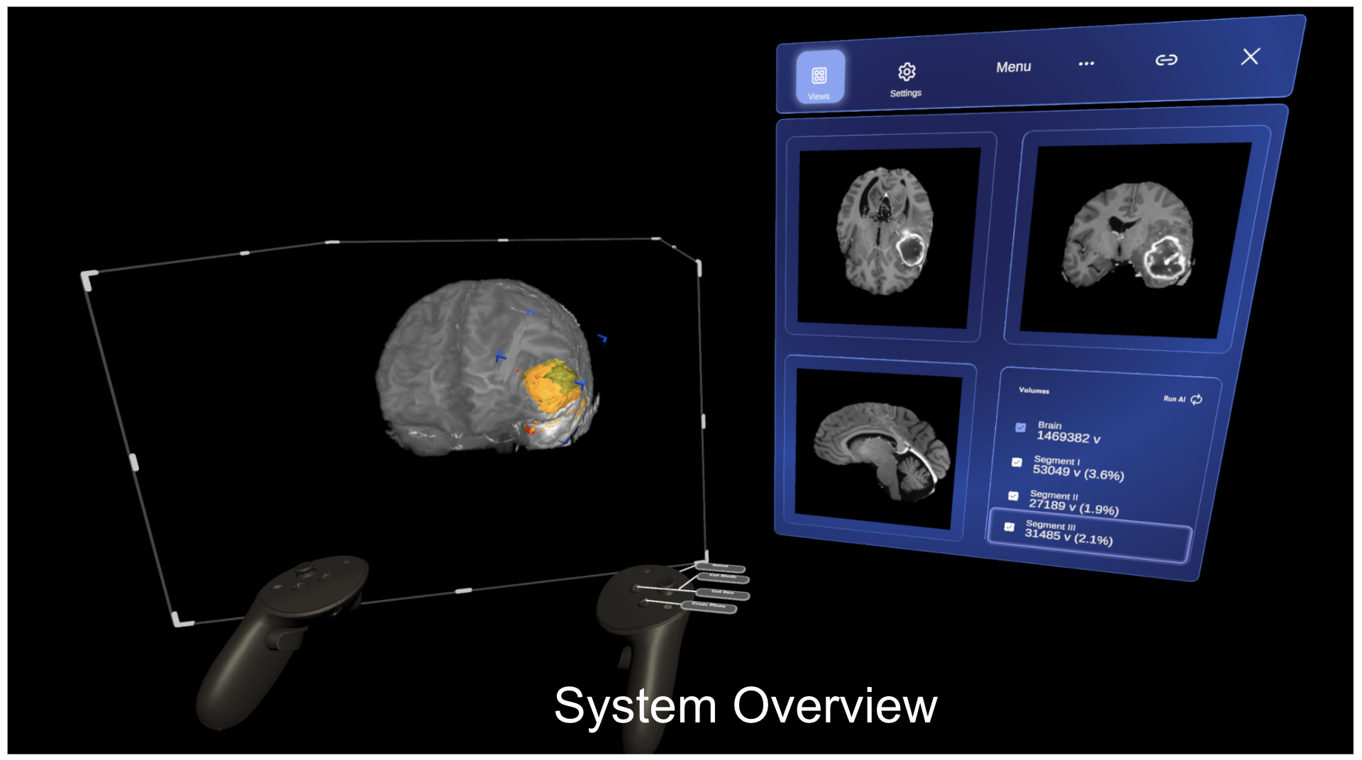  Brain Tumour Segmentation 
