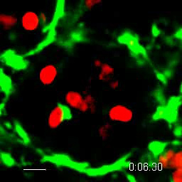 Inflamed glomerulus